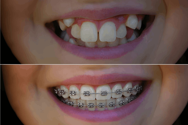 Orthodontics results