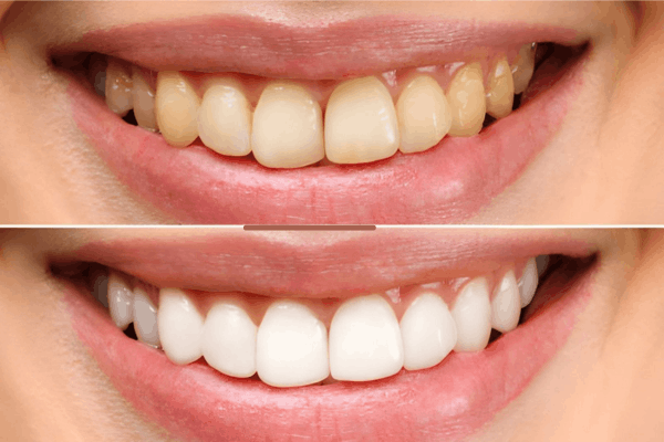 Teeth Whitening results