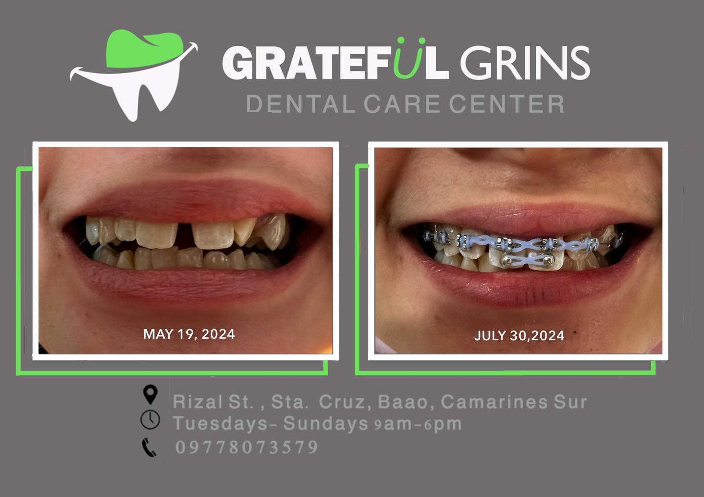 Grateful Grins Dental Clinic - Baao gallery